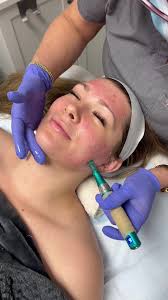 The primary benefit of microneedling
