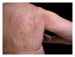 These skin rashes can be treated by use of home remedies and over the counter creams. Diverse Presentations Of Carcinoma Erysipelatoides From A Teaching Hospital In Australia