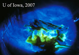 Image result for Seidel Test