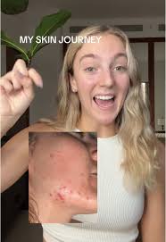 Transform Your Skin with tbh Skincare's Rebound Range