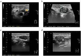 Also, would throat cancer cause a lump like this growing on the outside of the throat/neck? The Application Of Ultrasound In Detecting Lymph Nodal Recurrence In The Treated Neck Of Head And Neck Cancer Patients Scientific Reports