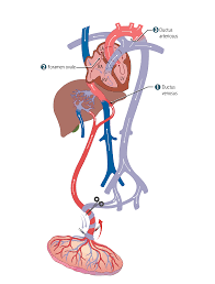 Image result for Delayed Transition from Fetal Circulation