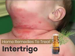 Intertrigo is a fancy name for a rash that shows up between the folds of skin.it is a very common skin rash that can crop up throughout life. How To Treat Intertrigo Safe And Effective Home Remedies Boldsky Com