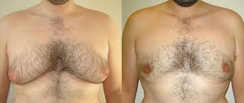 Breast Reduction Before And After Pictures Case 24 | Kalispell, Mt |  Mountain West Plastic Surgery
