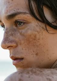 Image result for Freckled skin