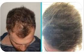 Hair Transplant Men Before And After Photo Hair Transplant Results Best Hair Transplant Hair Transplant