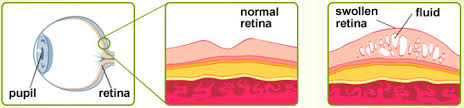 Qvision La FDA autoriza el ozurdex con restricciones para el edema macular diabético images?q=tbn:ANd9GcTz0jYbG4hZXDQgXRBT bx4Mq0Jnjg Dg buUiy2VmPbpOuudFT