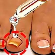 как сделать мазь от грибка ногтей из яйца и уксуса Pin On Zdorove 2