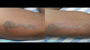 You might experience some discomfort around the treatment site, but it should not inhibit you from going about the cost of tattoo removal varies from patient to patient and depends on the size, color and location of the tattoo. Recosma Laser For Tattoo Removal First Session India Mumbai Auranabad Youtube
