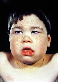 It is also seen in some native american peoples and occasionally in europeans (e.g., scandinavians. Alpha Thalassemia Mental Retardation Syndrome Wikipedia