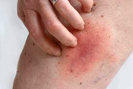 Image result for Pigment stains on the shin