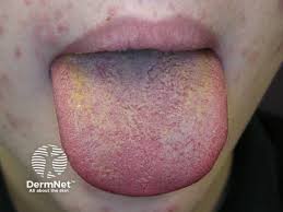Image result for black hairy tongue symptoms