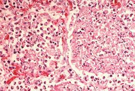 Pneumophila is the primary human pathogenic bacterium in this group and is the causative agent of legionnaires' disease, also known as legionellosis. File Legionella Pneumonia 3785990105 Jpg Wikimedia Commons