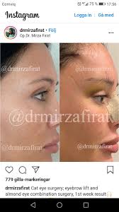 Pin By Lastrose On Estetik Eyebrow Lift Eyebrows Eye Surgery
