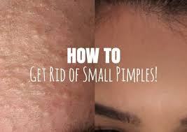 What Should You Do For Small Tiny Pimples On Face Natural Beauty Skin Club Pimples On Face Small Pimples How To Remove Pimples