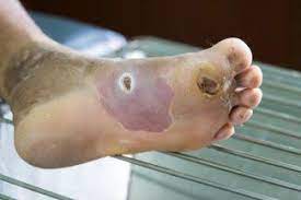 Icd 10 code diabetic foot ulcer wound. Classification Of Diabetic Foot Ulcers Woundsource