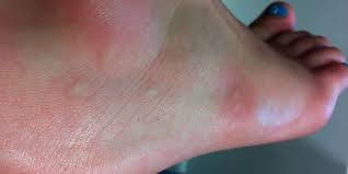 Maybe you would like to learn more about one of these? Ant Bites Everything There Is To Know And Beyond Miller Pest Termite
