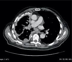 Approximately 35% of all mesotheliomas arise only from the peritoneum. Palliative Care For Patients With Mesothelioma British Journal Of Hospital Medicine
