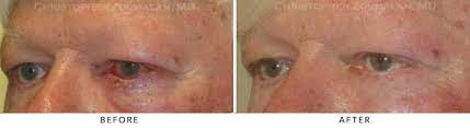 eyelid cancer can sometimes look like other conditions, such as blepharitis (inflammation of the eyelids). Eyelid Skin Cancer Excision Before And After Photo Gallery