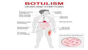 Foodborne botulism comes from eating foods contaminated with the toxin. Acidic Foods Risk Botulism And So Do North Dakota Lawmakers Food Safety News