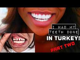 At aspen dental, a dedicated team of lab technician experts, craft custom dentures at your local dental office to match every smile. I Had My Teeth Done In Turkey Final Results Costs Youtube