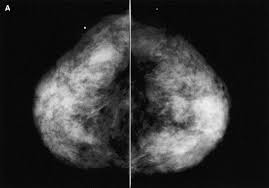 They are often caused by aging, an old ultrasound: Ultrasound For Breast Cancer Screening And Staging Radiologic Clinics