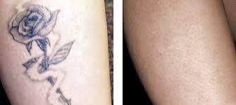 But before to discuss methods of tattoo removal, first below we will understand what things we have to consider before tattoo removal. Laser Tattoo Removal Melbourne Collins Cosmetic Clinic