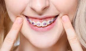 Orthodontics: Get A Perfect Smile With Braces & Invisalign.