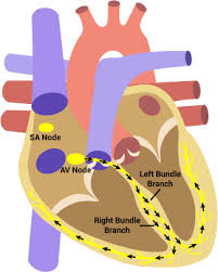 Image result for Right Bundle Branch Block