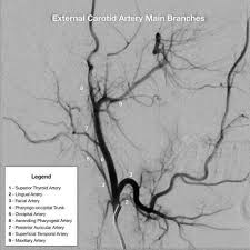 Check spelling or type a new query. Branches Of The External Carotid Artery Mnemonic Radiology Reference Article Radiopaedia Org