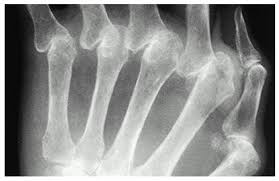 Image result for XRay Changes in Rheumatic Conditions