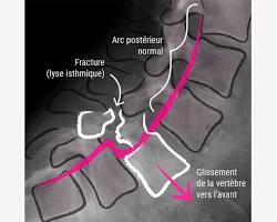 Image de Spondylolisthésis par lyse isthmique