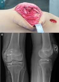 Maybe you would like to learn more about one of these? Scielo Brasil Femoral Condyle Osteochondral Fracture Treated With Bone Suture After Acute Patellar Dislocation A Case Report Femoral Condyle Osteochondral Fracture Treated With Bone Suture After Acute Patellar Dislocation A