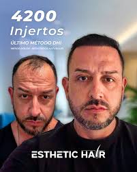 Turkish Hair Transplant in Cancun/Mexico