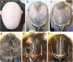 Hair loss is often distressing and can have a significant effect on the patient's quality of life. Alopecia Areata A Comprehensive Review Of Pathogenesis And Management Springerlink