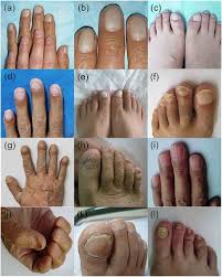 Image result for Koilonychia feet