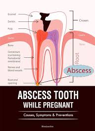 Abscess Tooth While Pregnant Causes Symptoms 038 Preventions You Should Be Aware Of Abscess Tooth Periodontitis Pregnant