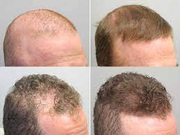Propecia or proscar (finasteride) is a medication that can help men grow back the hair that they lost. Using Finasteride To Treat Hair Loss Picante Today Hot News Today