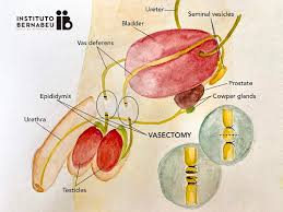 Check spelling or type a new query. How To Be A Parent After Vasectomy
