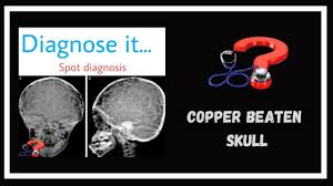 Head growth curve <ul><li>5/48 (10.41%) children had deceleration in head growth in the follow up period, of which only one child was symptomatic for raised icp and that child had bca as. Copper Beaten Skull Youtube