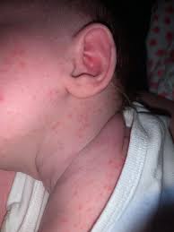 Image result for sweat rash on back baby