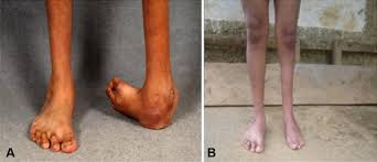 Club foot can affect 1 or both feet. The 2017 Abjs Nicolas Andry Award Advancing Personalized Medicine For Clubfoot Through Translational Research Springerlink