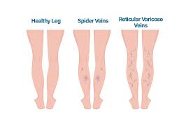 Varicose Veins Symptoms And Treatment Options Physicians Vein Clinics