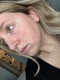 My husband has seemed to have broken out in a rash?? Not sure what it is.  Any suggestions