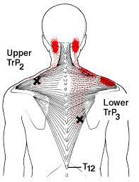 It is located very close to the skin. Referred Pain Patterns Red From The Upper And Lower Trapezius Muscle Download Scientific Diagram