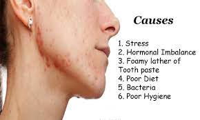 21 Hormonal Acne Pictures Ideas Hormonal Acne Acne Acne Pictures