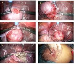 Laparoscopic sequence showing ovarian cyst removal and retrieval