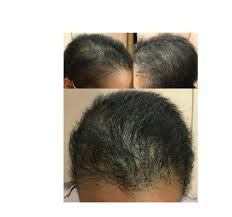 Dr. Donovan's Hair Loss Articles (2011-2024) — Donovan Hair Clinic