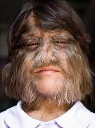 Werewolf syndrome is generally considered a genetic condition, but in these recent cases, it was seemingly caused by minoxidil, a medicine often used to treat male pattern baldness. Girl With Hypertrichosis Also Known As Werewolf Syndrome 9gag