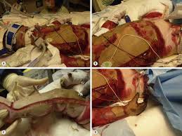 As nouns the difference between fasciotomy and escharotomy is that fasciotomy is (surgery) the cutting of the fascia to relieve tension or pressure (and treat the resulting loss of circulation to an area of tissue or muscle) while escharotomy is a surgical procedure in which an incision is made through eschar to expose the fatty tissue below. Burns Clinical Gate